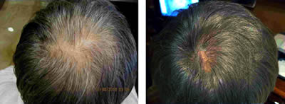 PRP kezelés hatása hajhulláskor