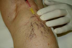 Visszértágulat injekciós scleroterapia