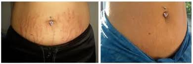 Stria és heg PRP, Drakula terápia-s kezelése